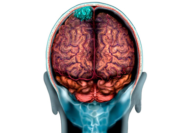 Meningiomas
